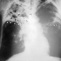 Gruźlica płuc