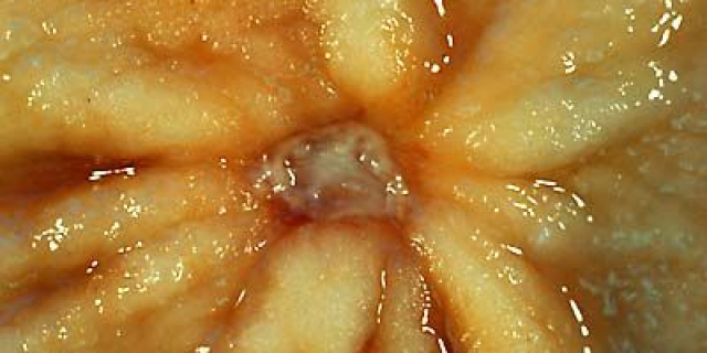 Wrzody budzą się na wiosnę