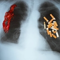 Nowotwór płuc